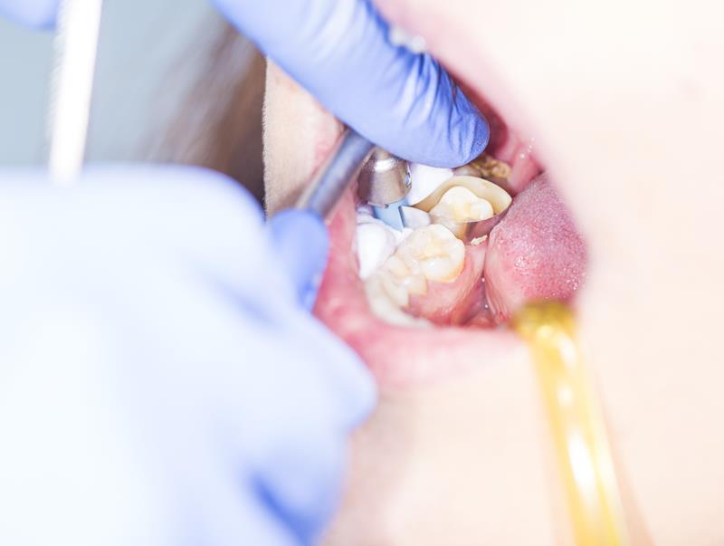 Cosmetic Bonding