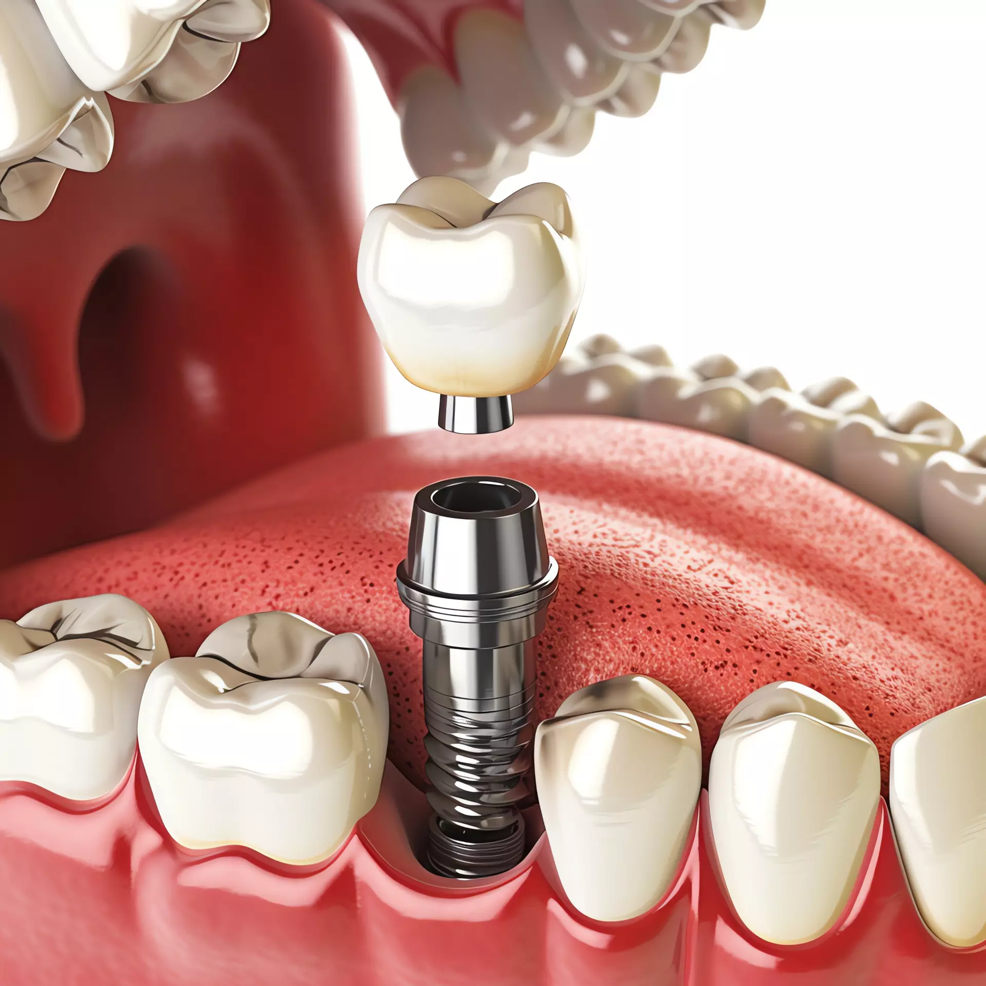 Dental Implants